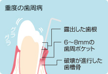 重度の歯周病説明イラスト